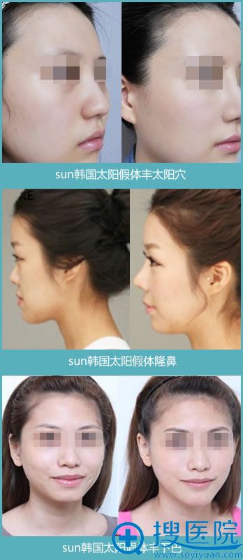 北京雅靓SUN面部假体案例效果 北京雅靓SUN面部假体案例效果
