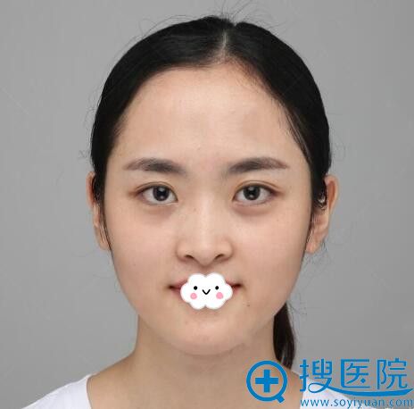 重庆华美假体+耳软骨隆鼻术前 重庆华美假体+耳软骨隆鼻术前
