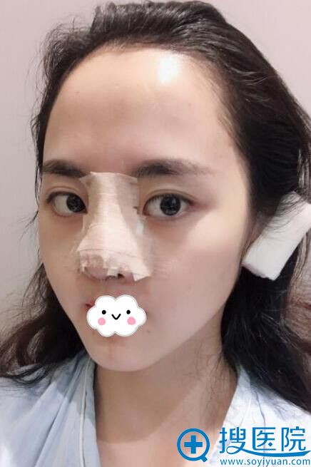 重庆华美假体+耳软骨隆鼻真人案例 重庆华美假体+耳软骨隆鼻真人案例