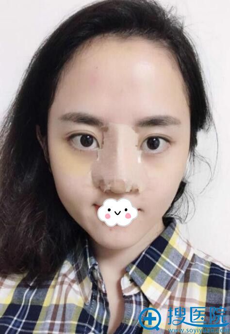 重庆华美耳软骨隆鼻案例 重庆华美耳软骨隆鼻案例