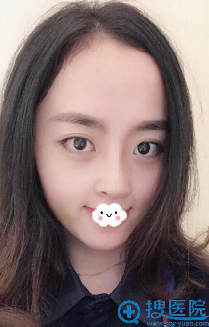 重庆华美整形医院假体隆鼻+耳软骨垫鼻尖 重庆华美整形医院假体隆鼻+耳软骨垫鼻尖