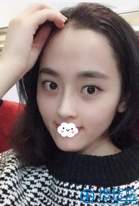 重庆华美整形美容医院假体隆鼻术后35天 重庆华美整形美容医院假体隆鼻术后35天