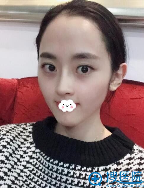 重庆华美整形美容医院耳软骨垫鼻尖恢复后 重庆华美整形美容医院耳软骨垫鼻尖恢复后