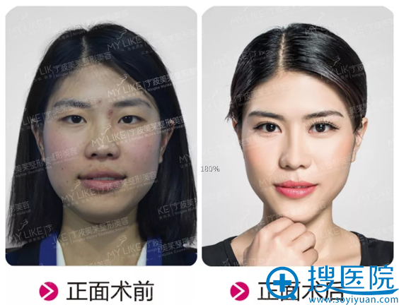 宁波美莱双眼皮和鼻综合隆鼻案例图 宁波美莱双眼皮和鼻综合隆鼻案例图