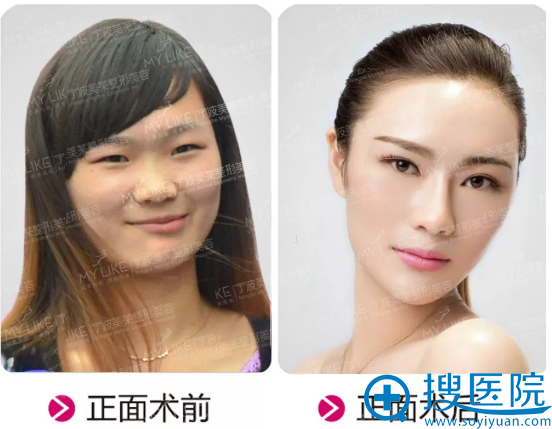 宁波美莱双眼皮隆鼻真人案例 宁波美莱双眼皮隆鼻真人案例