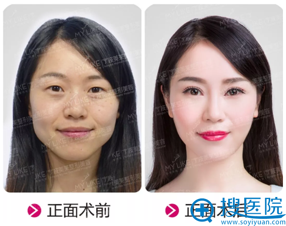 宁波美莱双眼皮隆鼻案例 宁波美莱双眼皮隆鼻案例