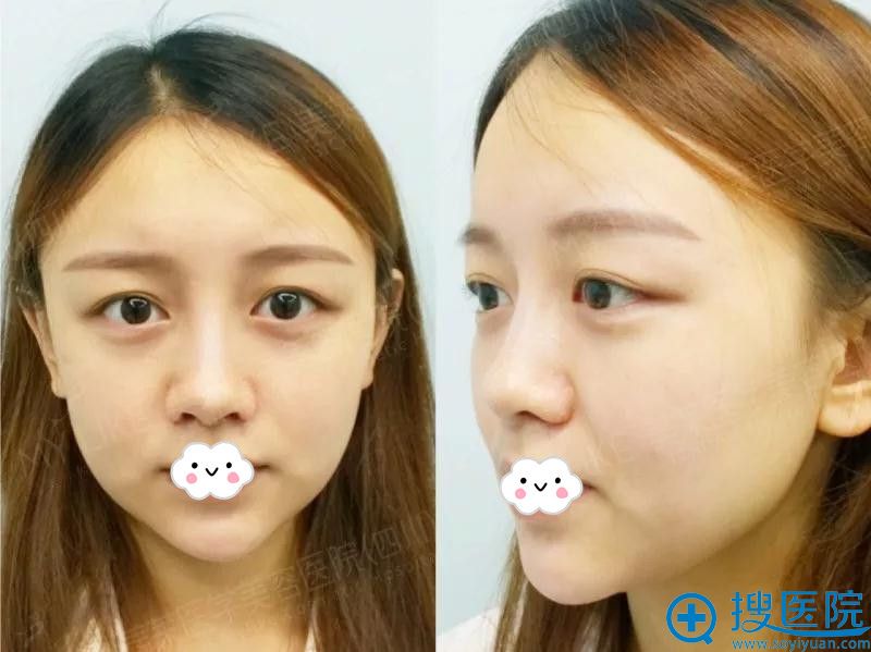 大饼脸的我到四川成都美莱雷状处做面部填充+双眼皮+隆鼻竟瘦脸