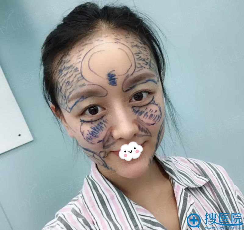 四川成都美莱面部填充+双眼皮+隆鼻术前 四川成都美莱面部填充+双眼皮+隆鼻术前