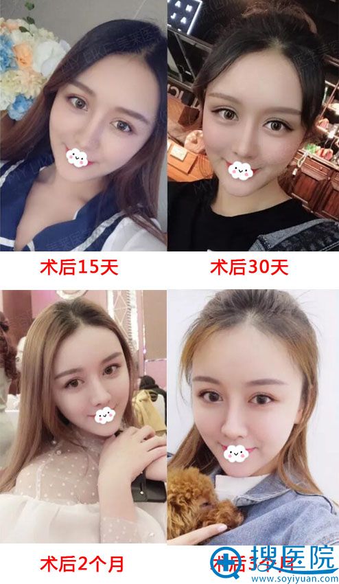 四川重庆美莱自体脂肪面部填充+双眼皮+隆鼻案例 四川重庆美莱自体脂肪面部填充+双眼皮+隆鼻案例