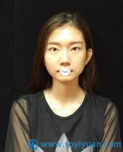 玻尿酸填充下巴后悔了找武汉新至美聂祝锋做硅胶假体下巴案例图