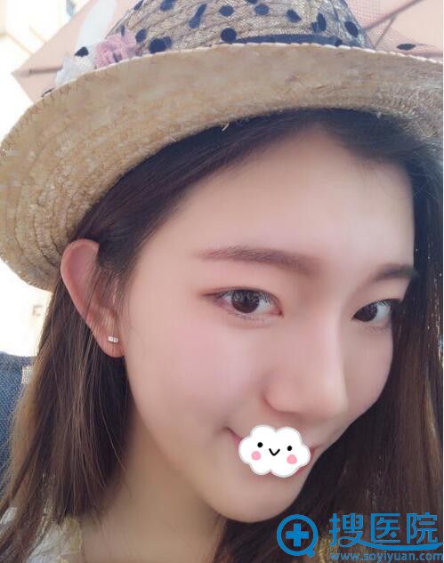 武汉新致美聂祝峰假体垫下巴效果图 武汉新致美聂祝峰假体垫下巴效果图