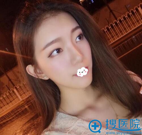 武汉新致美聂祝峰假体垫下巴术后恢复图 武汉新致美聂祝峰假体垫下巴术后恢复图