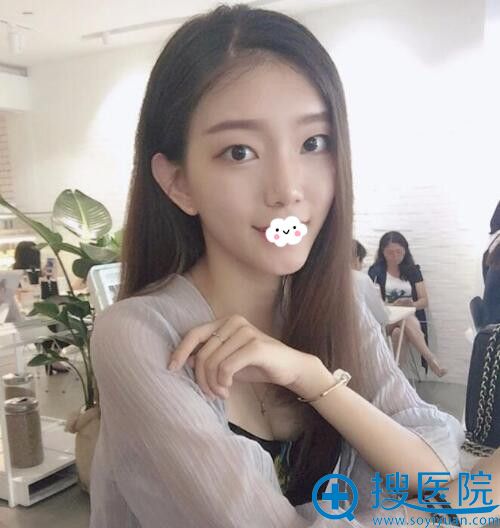 武汉新致美硅胶假体垫下巴术后恢复图 武汉新致美硅胶假体垫下巴术后恢复图