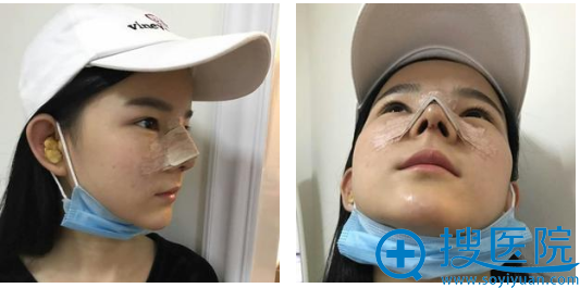 这是做完鼻子第三天的样子 这是做完鼻子第三天的样子
