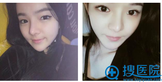 在贵阳美莱做完隆鼻一个月了 在贵阳美莱做完隆鼻一个月了