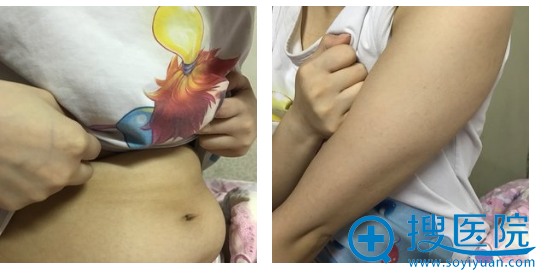 找上海瑞芙臣马昌华做完腰腹部抽脂和手臂吸脂后瘦到飞起来