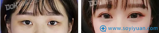 重庆铜雀台灵动双眼皮案例 重庆铜雀台灵动双眼皮案例