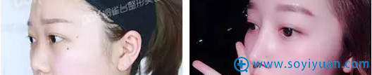 重庆铜雀台自然美鼻术后效果 重庆铜雀台自然美鼻术后效果