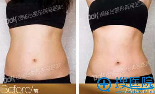 重庆铜雀台腰腹吸脂案例 重庆铜雀台腰腹吸脂案例
