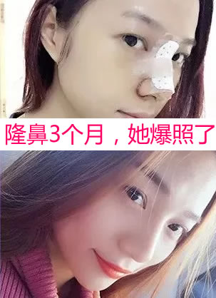 3个月前塌鼻梁大鼻头的我选择朋友推荐的茂名华美医院做了隆鼻