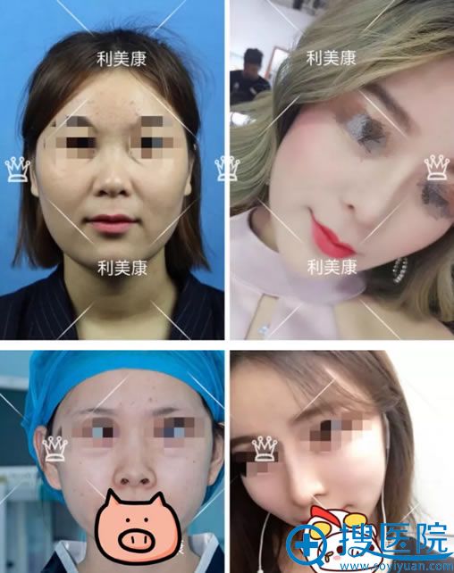 利美康全鼻整形张智毅隆鼻案例 利美康全鼻整形张智毅隆鼻案例