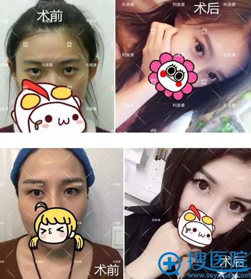 利美康眼部美雕医生刘德东双眼皮案例 利美康眼部美雕医生刘德东双眼皮案例