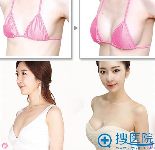 利美康美胸医生鲁天宇隆胸案例 利美康美胸医生鲁天宇隆胸案例
