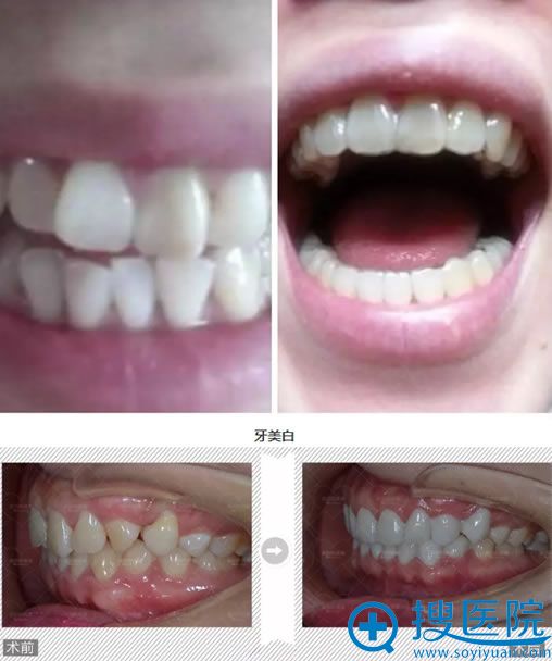 利美康口腔医院院长马正飞牙齿矫正案例 利美康口腔医院院长马正飞牙齿矫正案例