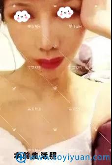 在惠州刘伟勇医疗美容找费博文韬做自体脂肪隆胸1个月恢复效果