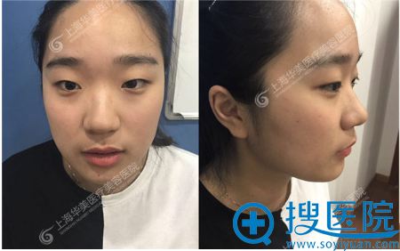 没错 我就是找上海华美许再荣割了双眼皮找李健做了隆鼻怎么样