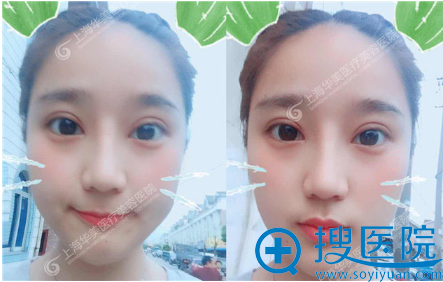 来上海华美做眼睛鼻子一个月了 来上海华美做眼睛鼻子一个月了