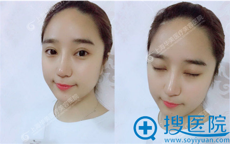 <!--<i data=20240710 data-id=16294></i>-->双眼皮案例两个月恢复图片 <!--<i data=20240710 data-id=16294></i>-->双眼皮案例两个月恢复图片