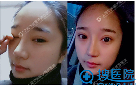 这是<!--<i data=20240710 data-id=16294></i>-->院长双眼皮案例4个月的样子 这是<!--<i data=20240710 data-id=16294></i>-->院长双眼皮案例4个月的样子