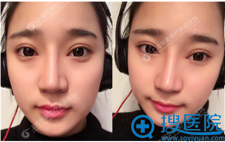 上海华美<!--<i data=20240710 data-id=16294></i>-->双眼皮李健隆鼻案例4个月 上海华美<!--<i data=20240710 data-id=16294></i>-->双眼皮李健隆鼻案例4个月