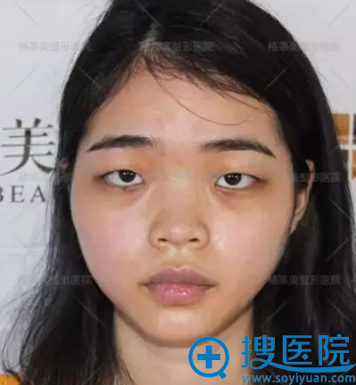 整形前的照片 整形前的照片