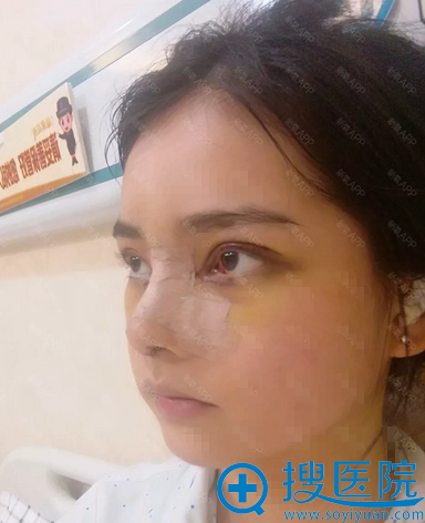 双眼皮隆鼻术后一周效果图 双眼皮隆鼻术后一周效果图