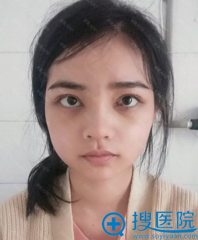 在福州格莱美做眼睛鼻子两周了 在福州格莱美做眼睛鼻子两周了
