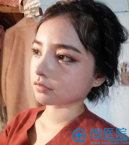 做完眼睛和鼻子手术16天侧面照片 做完眼睛和鼻子手术16天侧面照片