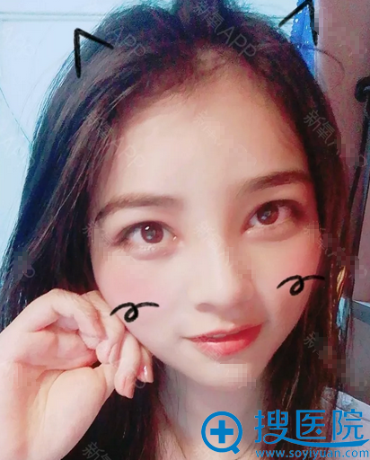 福州格莱美孙笠院长双眼皮隆鼻15天 福州格莱美孙笠院长双眼皮隆鼻15天