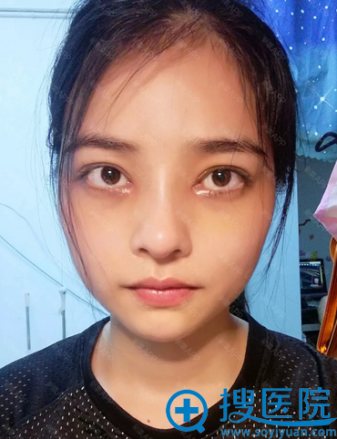 孙笠院长双眼皮和隆鼻案例1个月图片 孙笠院长双眼皮和隆鼻案例1个月图片