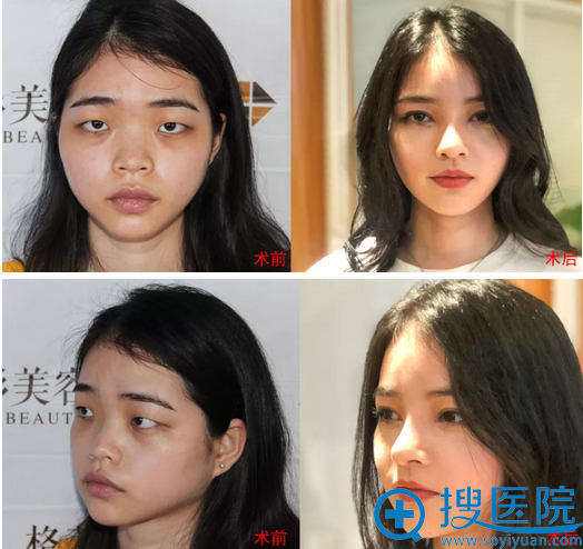 福州格莱美孙笠院长双眼皮隆鼻案例对比图 福州格莱美孙笠院长双眼皮隆鼻案例对比图