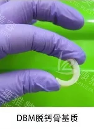 不想用假体和自体软骨隆鼻怎么办 用重庆康雅DBM脱钙骨基质材料