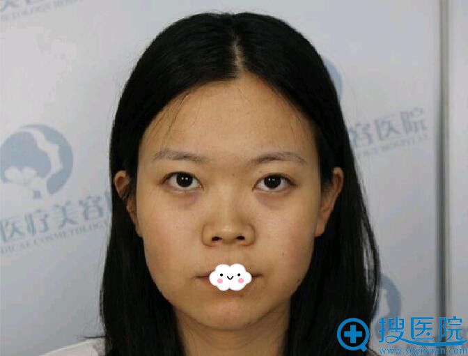 看了石家庄隆鼻好的整形医院排名后到蓝山王兴奎处做了鼻综合
