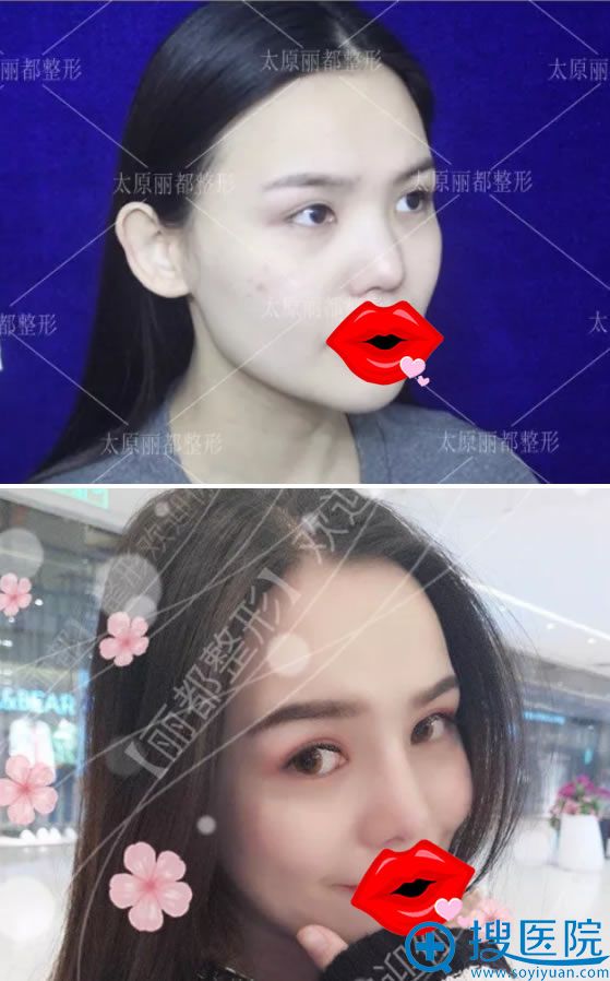 <!--<i data=20240710 data-id=12271></i>-->王新灿鼻综合真人案例 <!--<i data=20240710 data-id=12271></i>-->王新灿鼻综合真人案例