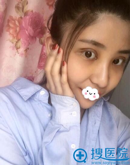 重庆军美医疗美容门诊部胡金香双眼皮案例 重庆军美医疗美容门诊部胡金香双眼皮案例