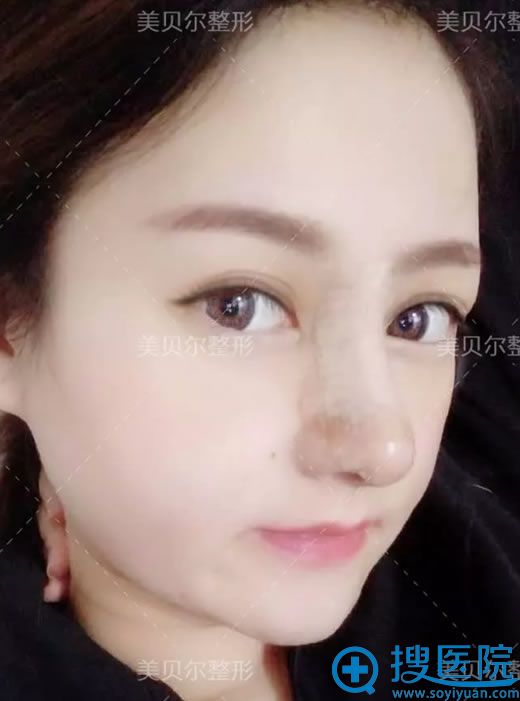 美贝尔鼻综合手术5天恢复效果图 美贝尔鼻综合手术5天恢复效果图