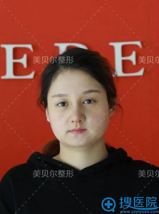 SMART鼻综合整形手术7天拆线照片 SMART鼻综合整形手术7天拆线照片