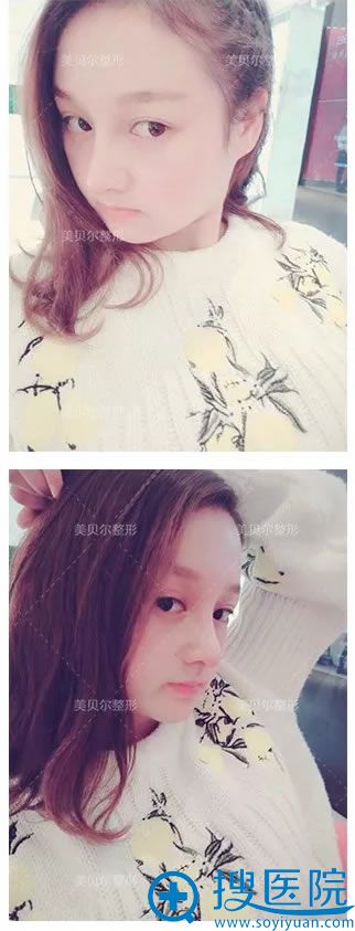找美贝尔邹志英医生做隆鼻15天效果 找美贝尔邹志英医生做隆鼻15天效果