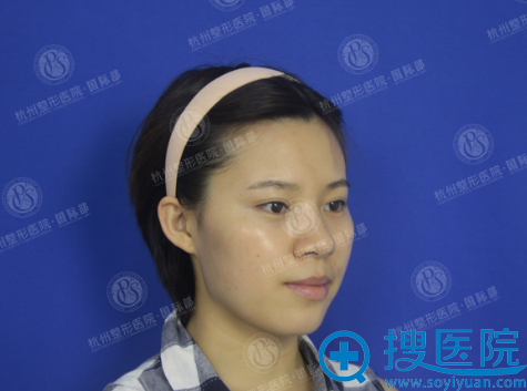 感觉在杭州整形医院国际部找沈剑做的自体脂肪丰额头饱满又自然