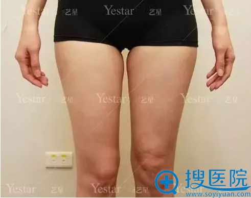 西安艺星大腿吸脂解决局部肥胖 脂肪提纯后填充面部不做黄脸婆